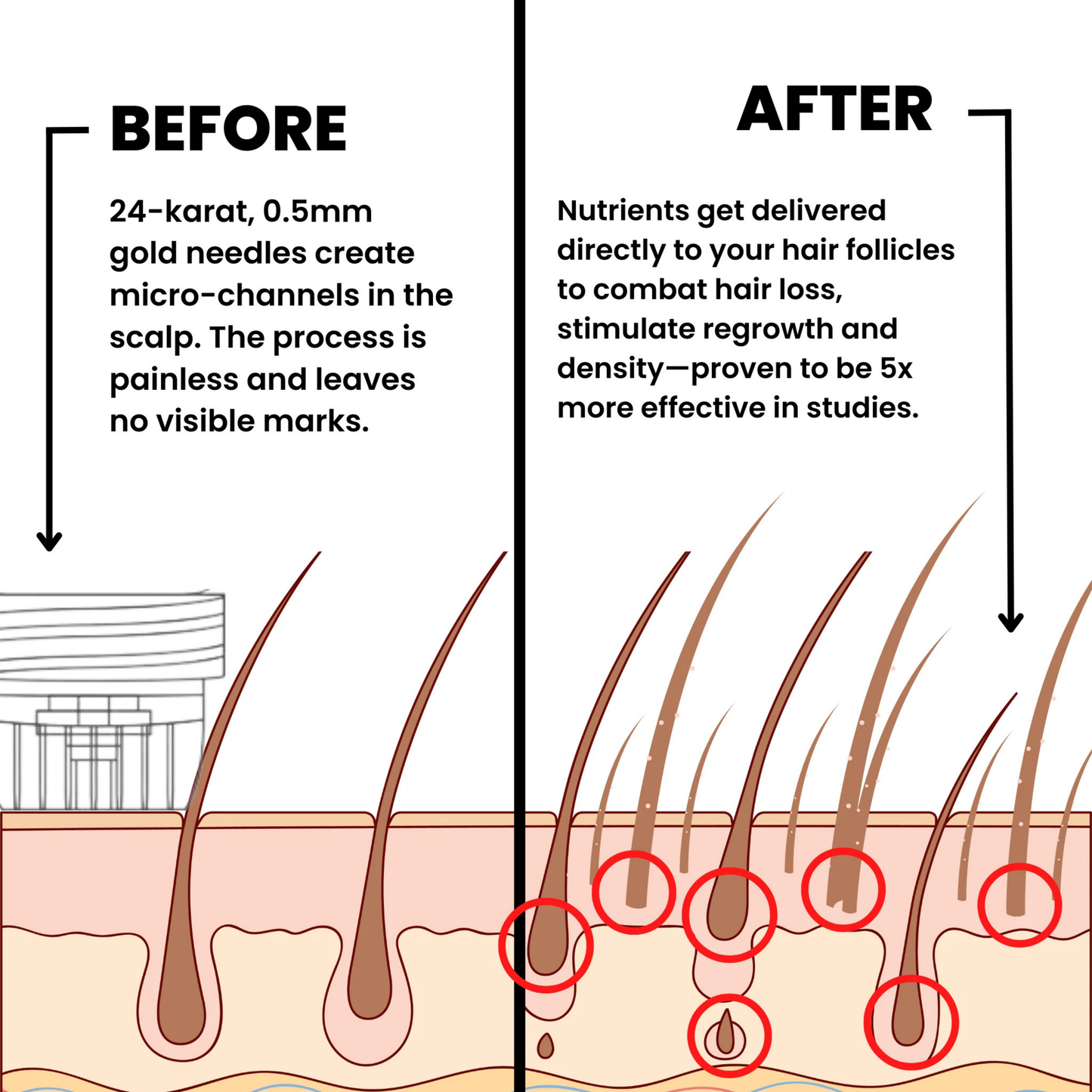 Infuse Microneedle Hair Regrowth Kit – Stimulates Scalp, Boosts Hair Growth & Thickening Treatment