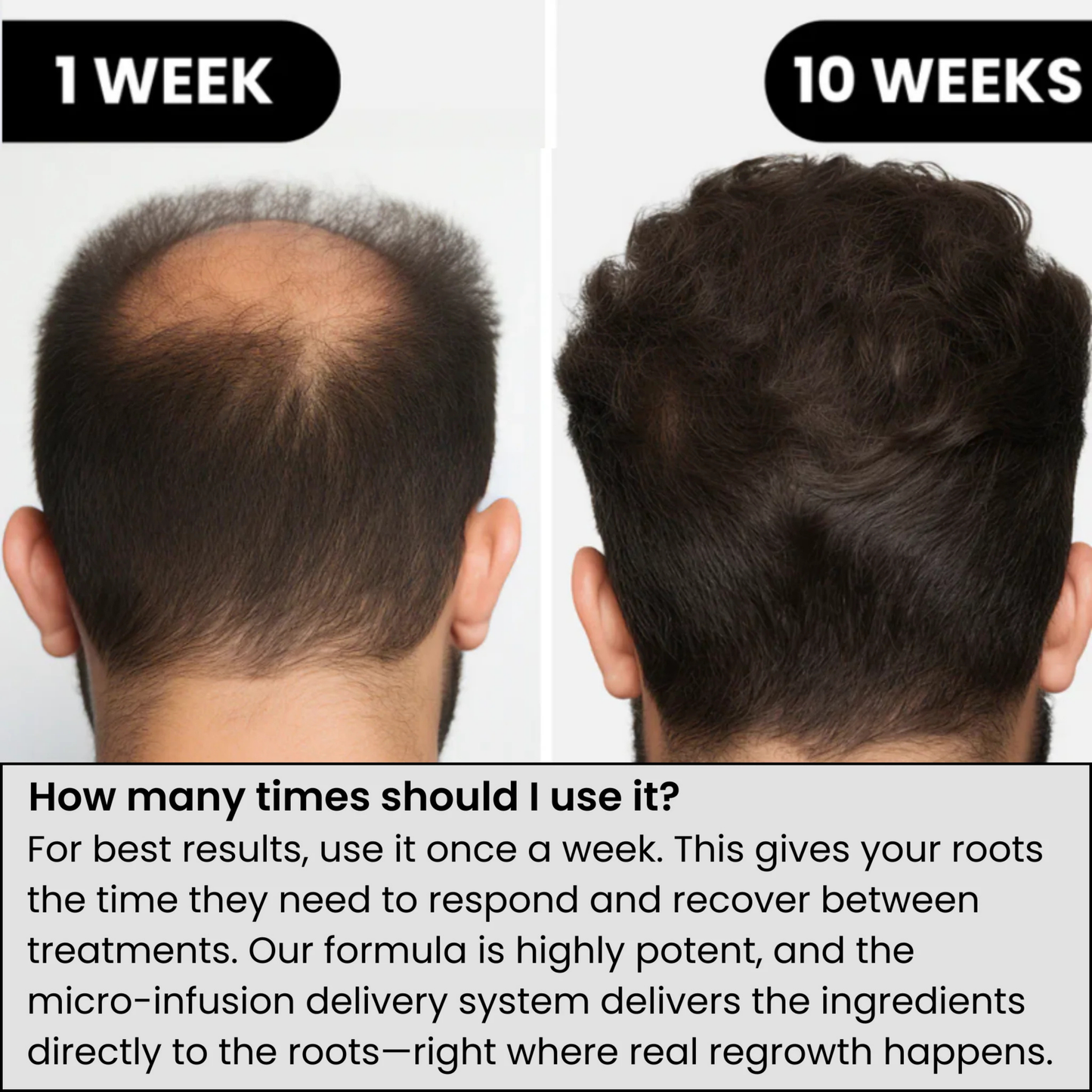 Infuse Microneedle Hair Regrowth Kit – Stimulates Scalp, Boosts Hair Growth & Thickening Treatment