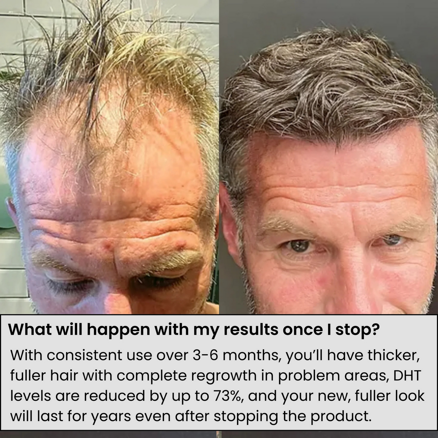 Infuse Microneedle Hair Regrowth Kit – Stimulates Scalp, Boosts Hair Growth & Thickening Treatment