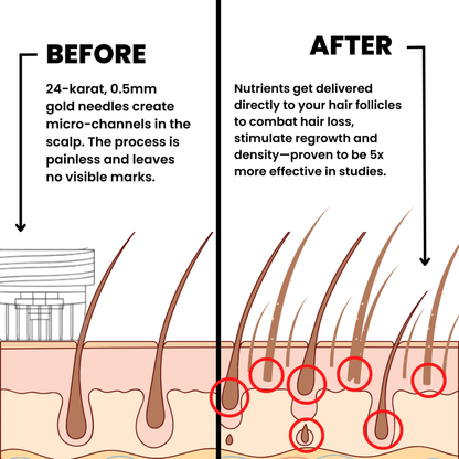 Infuse Microneedle Hair Regrowth Kit – Stimulates Scalp, Boosts Hair Growth & Thickening Treatment